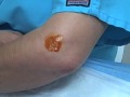 How to give an Injection for Tennis Elbow