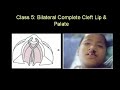 Classification of cleft lip & Palate,Clinical Pediatric Dentistry Classification of cleft lip & Palate,Clinical Pediatric Dentistry