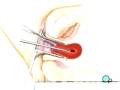 videos de Malpractice Medical Dilation and Curettage D and C Surgery  3
