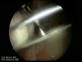 Laparoscopic Myomectomy