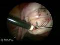Laparoscopic Myomectomy