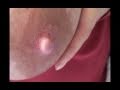 Breast Feeding Issues - Vasospasm Turns Pink