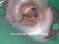 Localizaci�n de cuarto conducto en endodoncia
