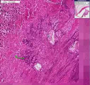 Histopathology Heart, aortic valve ...