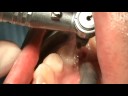 Implante Dental minimamente invasivo Implante Dental minimamente invasivo