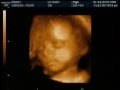 Baby Carson-Pedri Ultrasound
