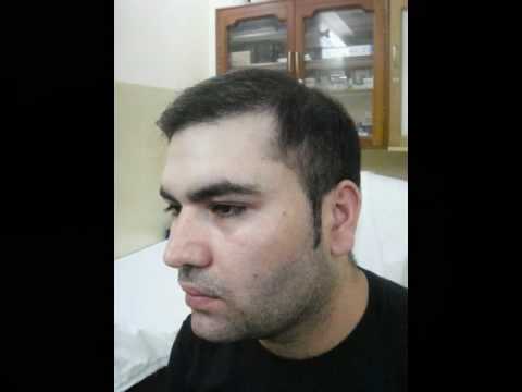 how to get a free hair transplant uk