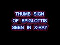 Acute Epiglottitis