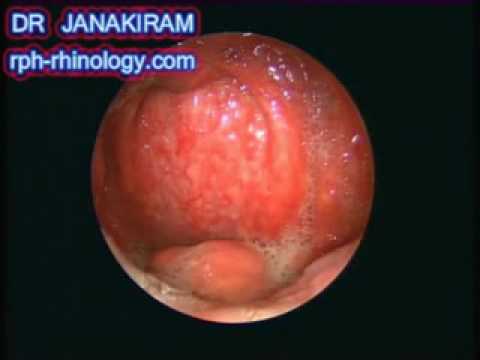 how to cure epiglottitis