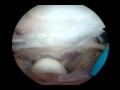 Arthroscopic Excision Of Elbow Joint Loose Part Arthroscopic Excision Of Elbow Joint Loose Part