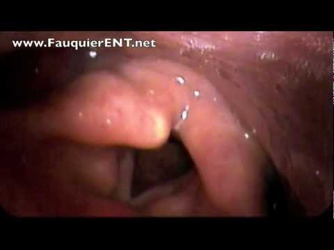 how to unclog your vocal cords
