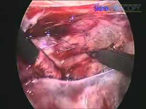 how to identify air leak in chest tube