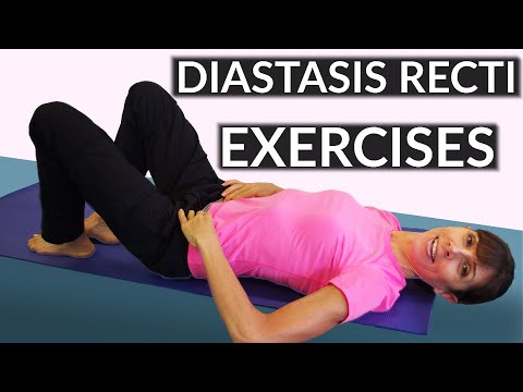 how to repair diastasis recti