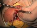 Tennison-Randall Suturing part 2