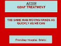 GDNF FOR PARKINSON\ GDNF FOR PARKINSON\
