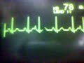 ECG Video: Ectopics - Atrial