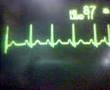 ECG Video: Ectopics - Atrial