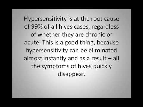 how to eliminate hives