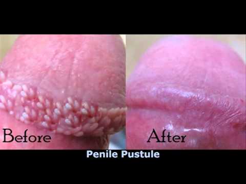 how to cure ppp pearly penile papules