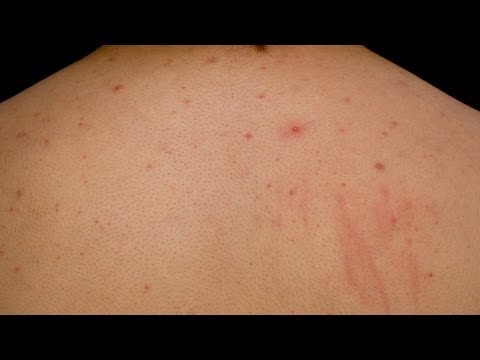 how to cure acne on back