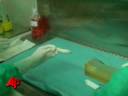 Breakthrough Windpipe Transplant Uses Stem Cells