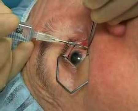 Subtenon Injection