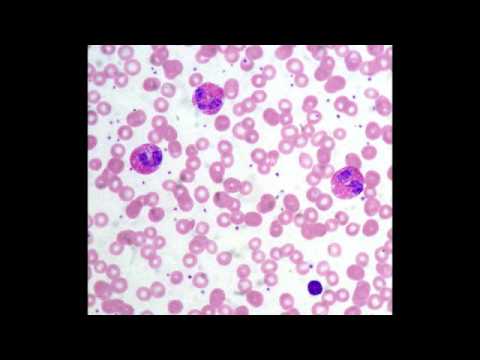 how to cure high eosinophils count