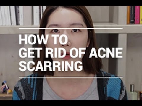 how to keep acne from scarring