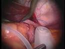 Lap Gastric Banding