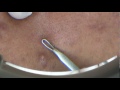 Professional pimple pop! (Part 1)