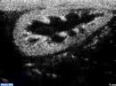 Sudan PIHI Kidney