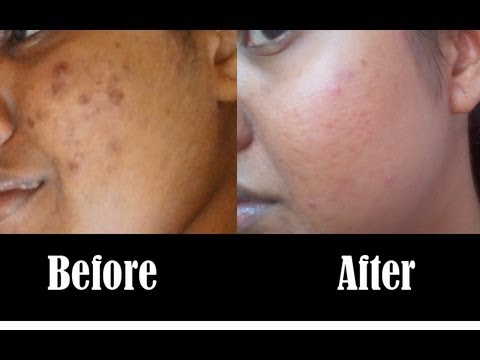 how to quickly fade acne scars
