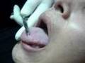 Nyelvpiercing, nyelvpiercingek, nyelvpiercing igy készül. Luks Scoot poe pircing na lingua VGS