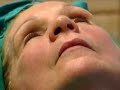 Lifestyle Lift Facelift - Dr. Fechner Boston