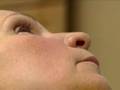 Lifestyle Lift Facelift - Dr. Fechner Boston