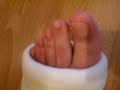 crutching in a white short leg cast
