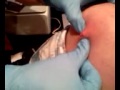 Exploding cyst