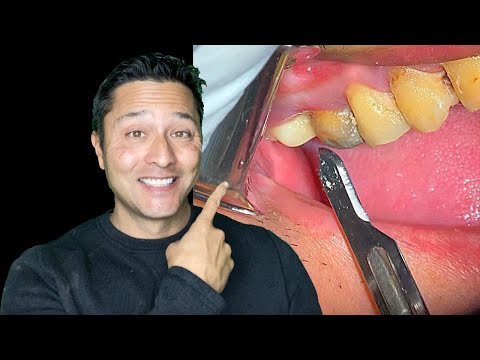how to drain tooth abscess at home