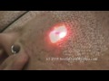 Laser Acne Scar Removal Treatment - Hispanic Patient