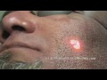 Laser Acne Scar Removal Treatment - Hispanic Patient