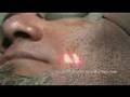 Laser Acne Scar Removal Treatment - Hispanic Patient