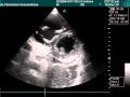 Severe Right Ventricle Dilatation In Echo Examination Severe Right Ventricle Dilatation In Echo Examination