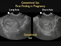 Go to www.sonosite.com for more videos and information about ultrasound technology. This video focuses on how OB ultrasound has evolved to be one of the most helpful applications of sonography in an emergency department because it can be used to diagnose or detect intrauterine pregnancies. This video also discusses the use of transvaginal and transabdominal ultrasound for detecting intrauterine pregnancies. To receive notifications about the YouTube videos from SonoSite, click the Subscribe button to subscribe to this channel. For a more comprehensive and portable video library, please download the SonoAccess™ iPhone® app at www.sonoaccess.com. Become a fan! Keep up with SonoSite on Twitter (http and Facebook (bit.ly