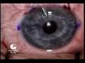 I actually had lenses implanted in my eyes.