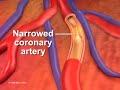 Percutaneous coronary Intervention stenting Percutaneous coronary Intervention stenting