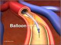 Percutaneous coronary Intervention stenting