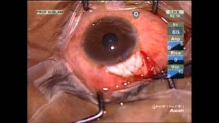 Releaseable suture in Trabeculectomy