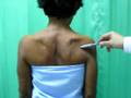 Muscle Atrophy And Rotator Cuff Tear