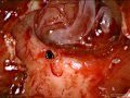 3D Endoscopic Endonasal Extended Transsphenoidal Resection of Craniopharyngioma-James K. Liu, MD
