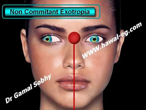how to perform ocular motility test